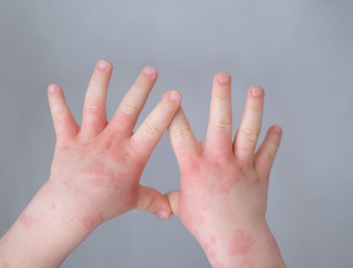 Food Allergies and Infants - A Comprehensive Guide, Close,Up,Kids,Hand,With,Allergic,Rash,Or,Eczema.,Severe